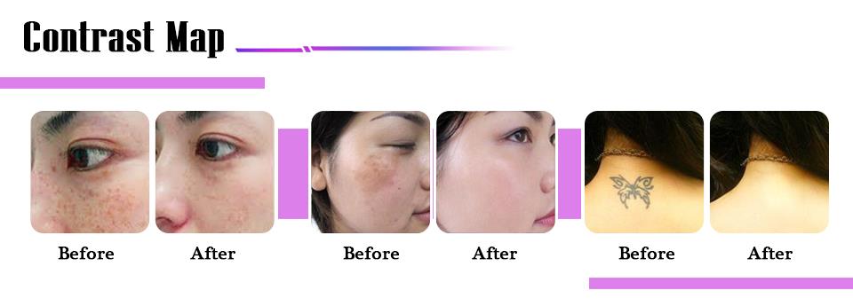 Portable Picosecond Laser For All Color Tattoo Treatment /skin Rejuvenation Pico Device Portable Picosecond Laser For All Color Tattoo Treatment /skin Rejuvenation Pico Device