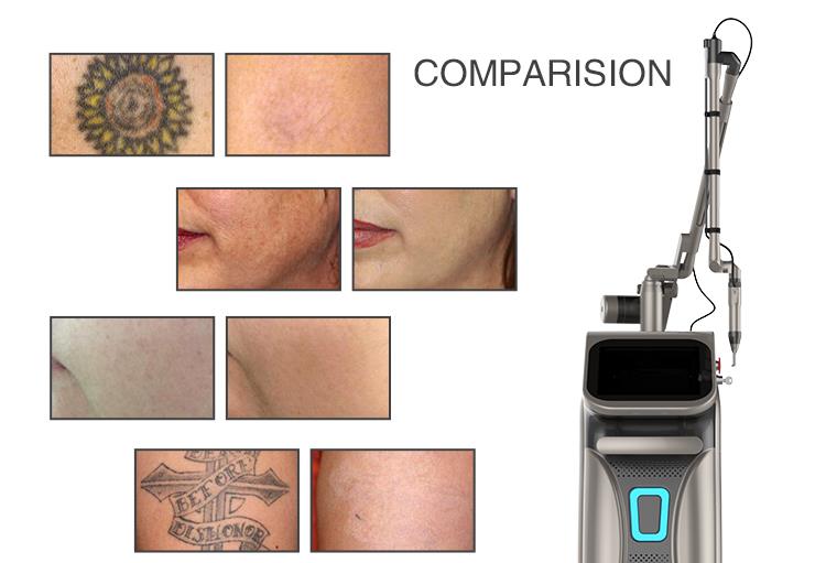Portable Pico Laser Machine Carbon Mask Laser/tattoo Removal Laser For Sale Portable Pico Laser Machine Carbon Mask Laser/tattoo Removal Laser For Sale