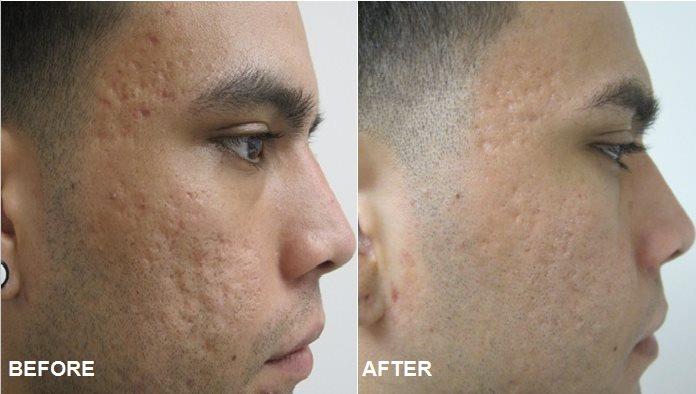 Hot!!Acne Scars Laser Skin Treatment Fraction C02 Laser