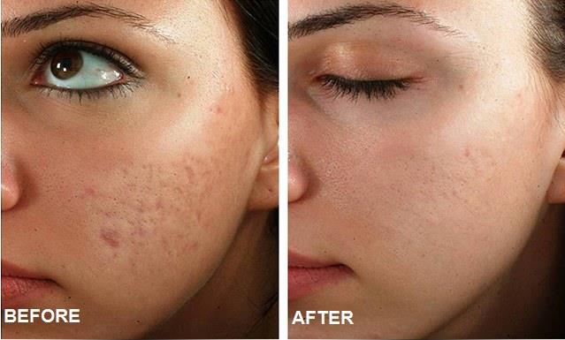 Hot!!Acne Scars Laser Skin Treatment Fraction C02 Laser